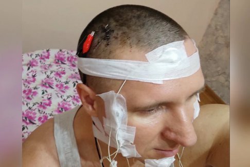 俄羅斯男子在家給自己做腦部植入芯片手術差點喪命
