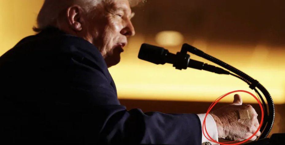 美國總統唐納德·特朗普在一次活動中發表講話時,右手上貼著創口貼。